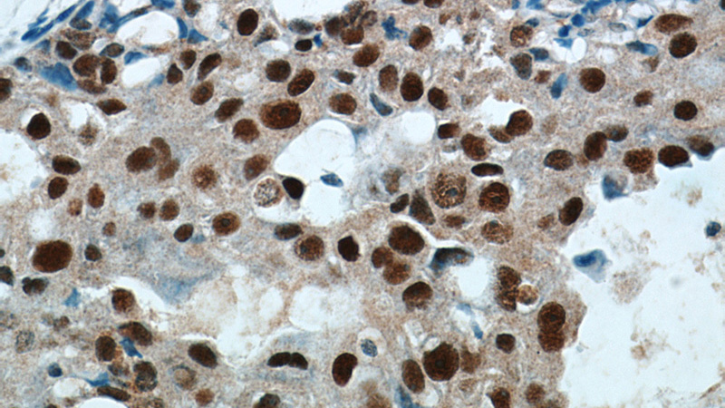 Immunohistochemical of paraffin-embedded human breast cancer using Catalog No:111304(HEXIM1 antibody) at dilution of 1:50 (under 40x lens)