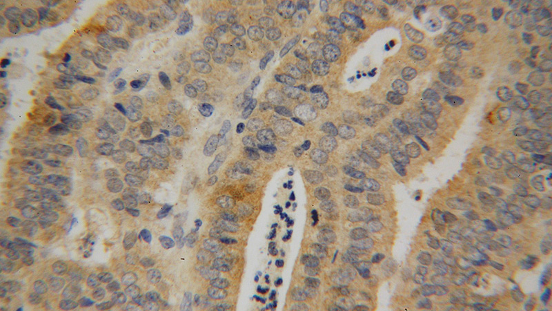 Immunohistochemical of paraffin-embedded human endometrial cancer using Catalog No:114613(RBM41 antibody) at dilution of 1:100 (under 40x lens)