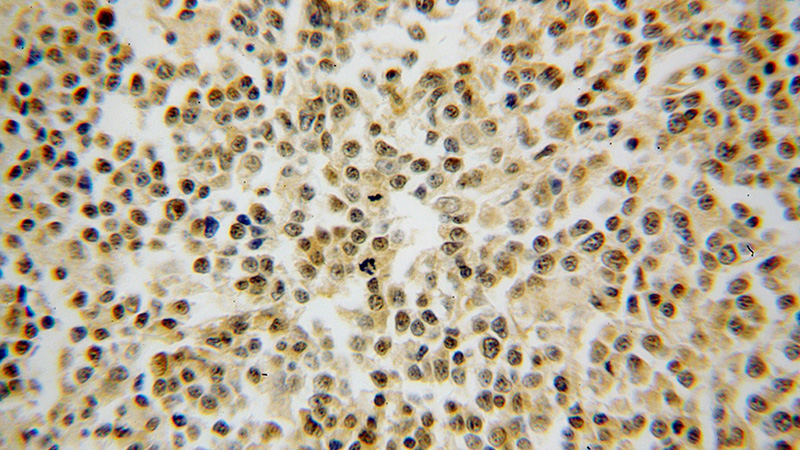 Immunohistochemical of paraffin-embedded human lymphoma using Catalog No:116724(VBP1 antibody) at dilution of 1:100 (under 40x lens)