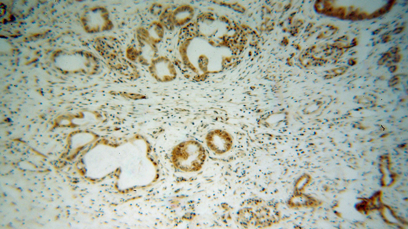 Immunohistochemical of paraffin-embedded human pancreas cancer using Catalog No:113847(PRKCB antibody) at dilution of 1:50 (under 10x lens)