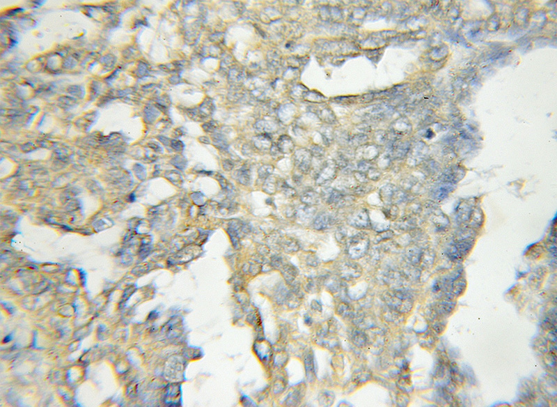 Immunohistochemical of paraffin-embedded human ovary tumor using Catalog No:113430(OSBPL11 antibody) at dilution of 1:50 (under 10x lens)