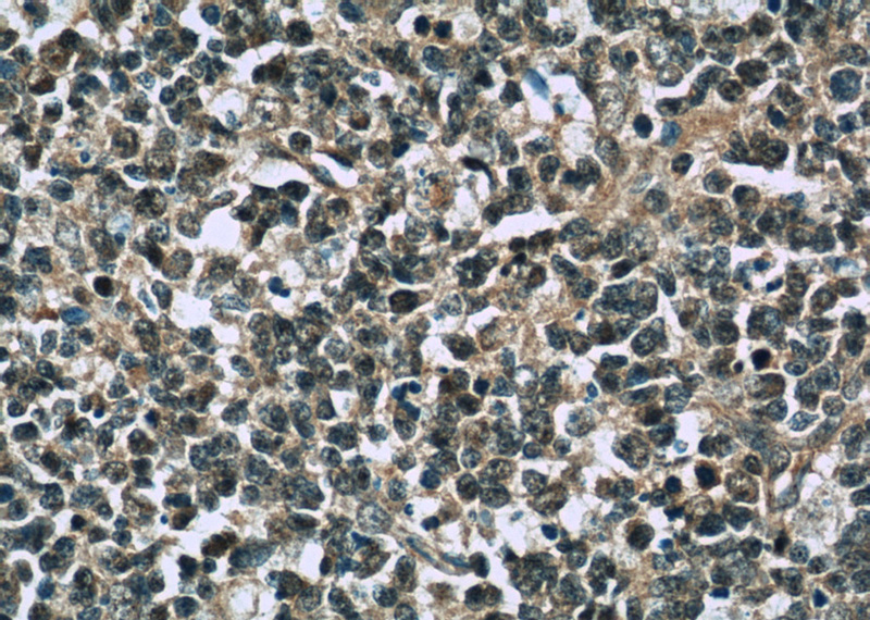 Immunohistochemistry of paraffin-embedded human tonsillitis slide using Catalog No:116016(TFPT Antibody) at dilution of 1:50