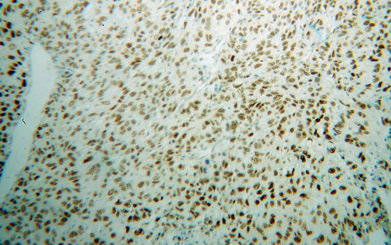Immunohistochemical of paraffin-embedded human lung cancer using Catalog No:110538(FBLIM1 antibody) at dilution of 1:100 (under 10x lens)