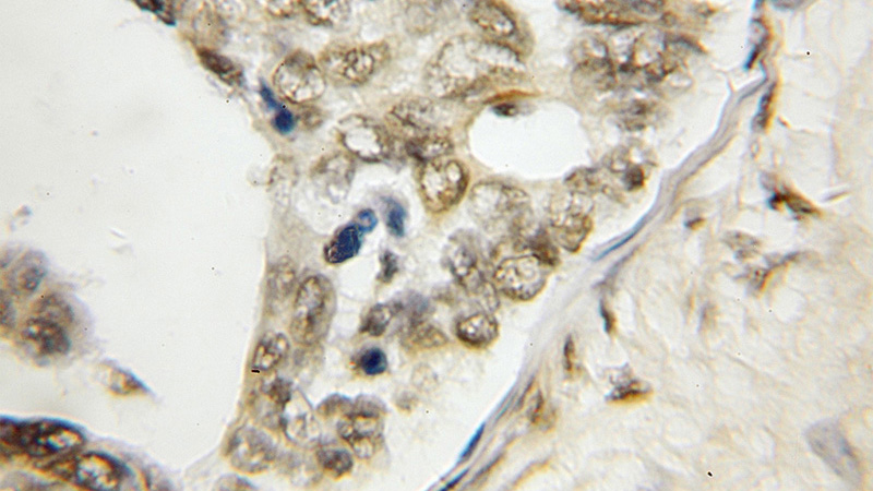 Immunohistochemical of paraffin-embedded human ovary tumor using Catalog No:116653(UBLCP1 antibody) at dilution of 1:50 (under 10x lens)