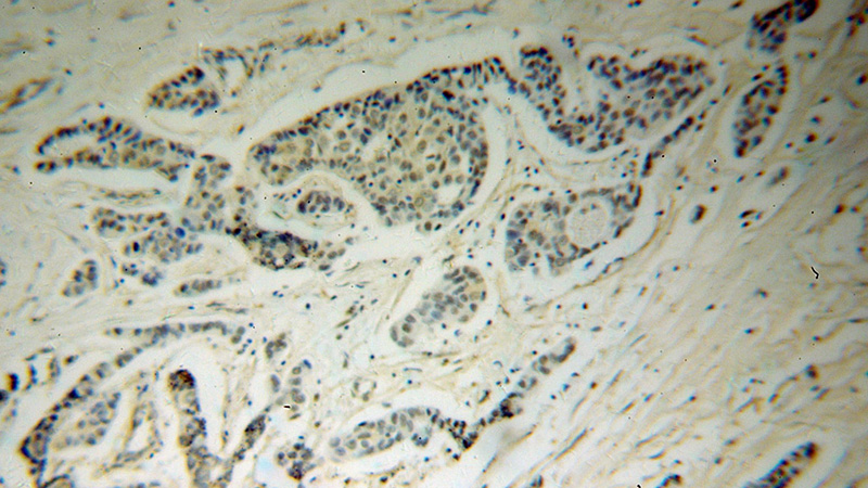 Immunohistochemical of paraffin-embedded human breast cancer using Catalog No:107941(AKR1C3 antibody) at dilution of 1:100 (under 10x lens)