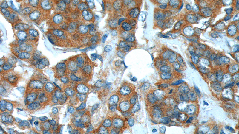 Immunohistochemistry of paraffin-embedded human breast cancer tissue slide using Catalog No:115469(SNX1 Antibody) at dilution of 1:200 (under 40x lens).