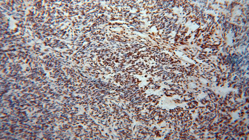 Immunohistochemical of paraffin-embedded human gliomas using Catalog No:115927(TARDBP antibody) at dilution of 1:100 (under 10x lens)