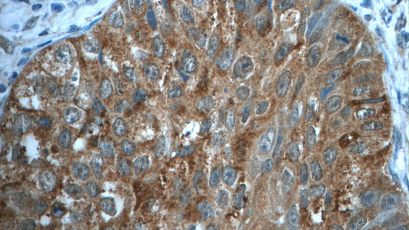 Immunohistochemistry of paraffin-embedded human lung cancer tissue slide using Catalog No:112697(MMP12 Antibody) at dilution of 1:50 (under 40x lens)