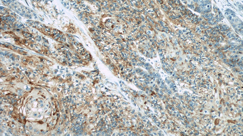 Immunohistochemical of paraffin-embedded human oesophagus cancer using Catalog No:109235(CHMP4B antibody) at dilution of 1:50 (under 10x lens)