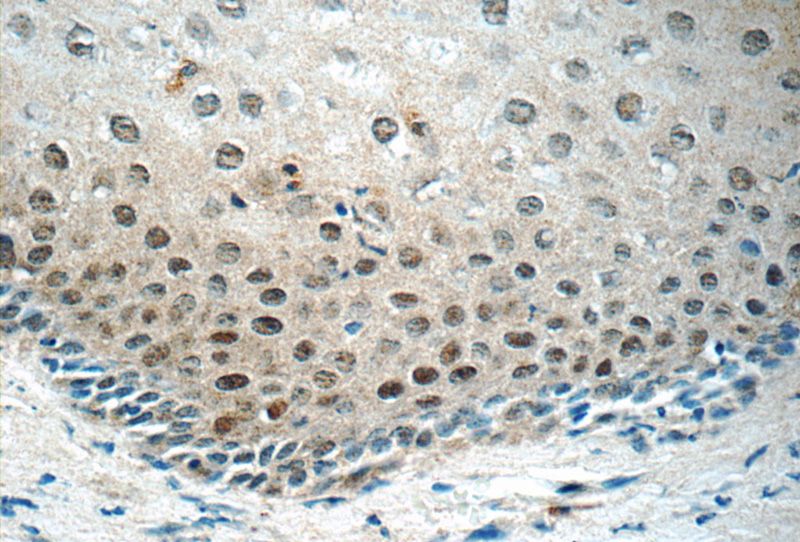 Immunohistochemistry of paraffin-embedded human cervix tissue slide using Catalog No:109207(CHAF1A Antibody) at dilution of 1:50 (under 40x lens)