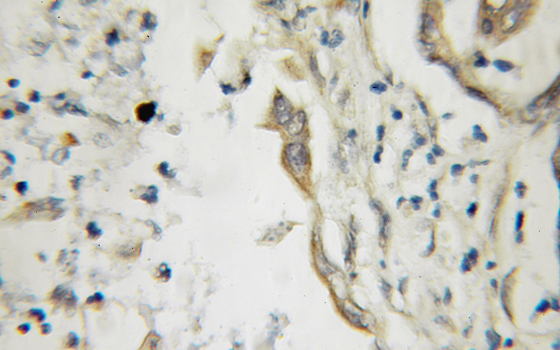 Immunohistochemical of paraffin-embedded human pancreas cancer using Catalog No:109505(PASP antibody) at dilution of 1:50 (under 40x lens)