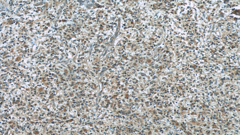 Immunohistochemical of paraffin-embedded human gliomas using Catalog No:107083(BCS1L antibody) at dilution of 1:50 (under 10x lens)