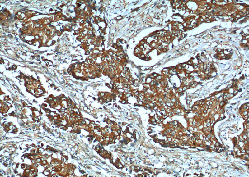 Immunohistochemistry of paraffin-embedded human breast cancer tissue slide using Catalog No:116138(TIMP1 Antibody) at dilution of 1:50 (under 10x lens)