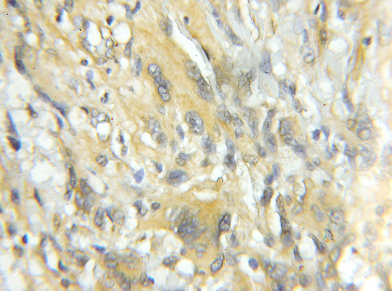Immunohistochemical of paraffin-embedded human gliomas using Catalog No:116317(TRIM44 antibody) at dilution of 1:50 (under 10x lens)