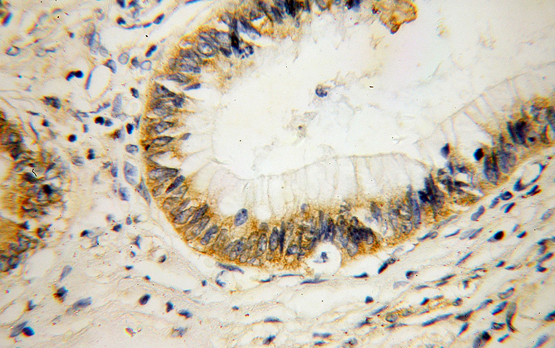 Immunohistochemical of paraffin-embedded human colon cancer using Catalog No:114815(RPL14 antibody) at dilution of 1:100 (under 40x lens)