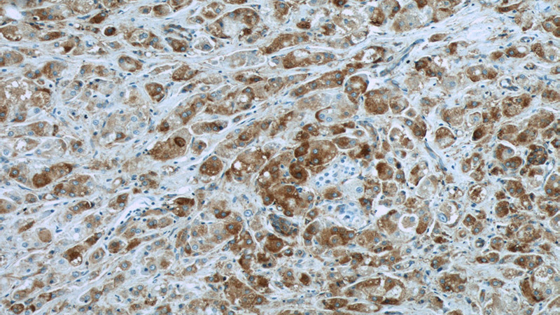 Immunohistochemistry of paraffin-embedded human breast cancer slide using Catalog No:117097(BCL2L12 Antibody) at dilution of 1:50