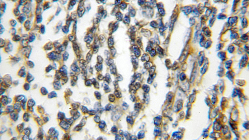 Immunohistochemical of paraffin-embedded human lymphoma using Catalog No:111778(IL21R antibody) at dilution of 1:10 (under 10x lens)