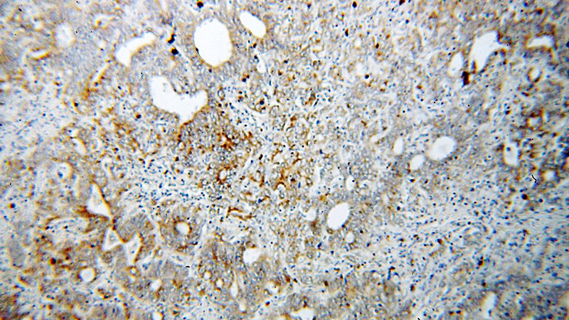 Immunohistochemical of paraffin-embedded human stomach cancer using Catalog No:108838(CAPN9 antibody) at dilution of 1:100 (under 10x lens)