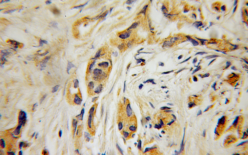 Immunohistochemical of paraffin-embedded human prostate cancer using Catalog No:109504(CP110 antibody) at dilution of 1:100 (under 10x lens)