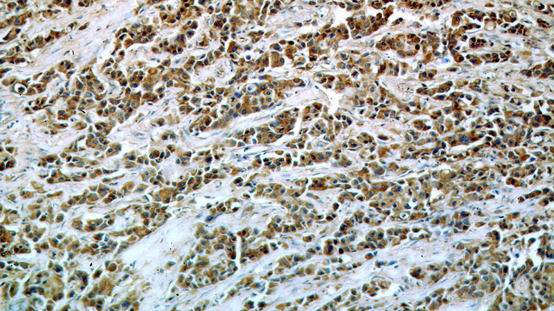 Immunohistochemical of paraffin-embedded human breast cancer using Catalog No:115280(PTPN11 antibody) at dilution of 1:100 (under 10x lens)