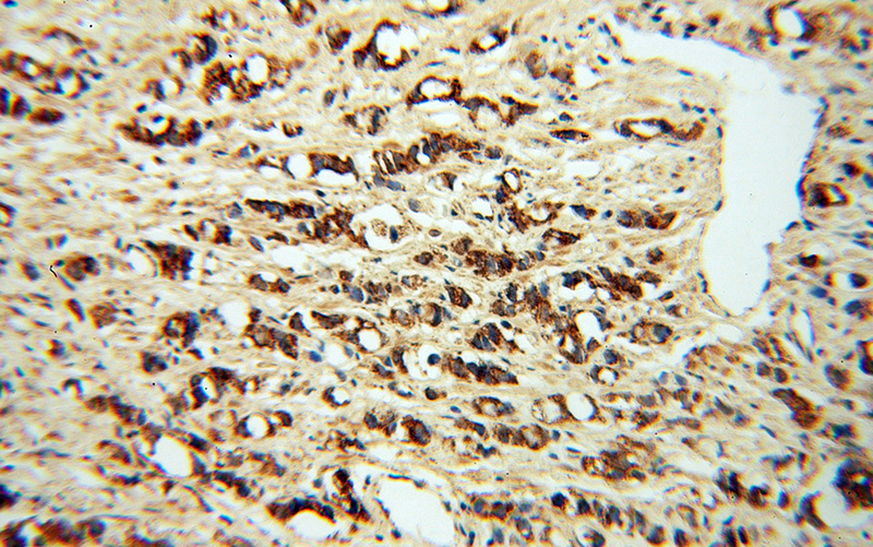 Immunohistochemical of paraffin-embedded human prostate cancer using Catalog No:113675(PDGFD antibody) at dilution of 1:50 (under 10x lens)