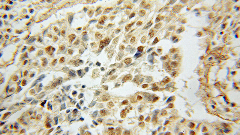 Immunohistochemical of paraffin-embedded human ovary tumor using Catalog No:110666(FIP1L1 antibody) at dilution of 1:50 (under 10x lens)