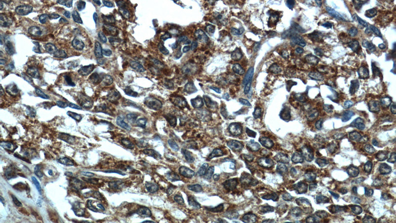 Immunohistochemistry of paraffin-embedded human prostate cancer tissue slide using Catalog No:108110(C5orf39 Antibody) at dilution of 1:50 (under 40x lens)