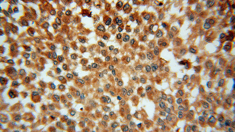 Immunohistochemical of paraffin-embedded human breast cancer using Catalog No:114077(PPA1 antibody) at dilution of 1:50 (under 40x lens)