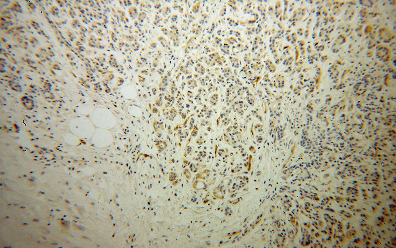 Immunohistochemical of paraffin-embedded human pancreas cancer using Catalog No:114521(RDX antibody) at dilution of 1:100 (under 10x lens)