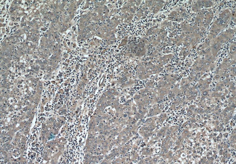 Immunohistochemical of paraffin-embedded human liver cancer using Catalog No:112701(MMP20 antibody) at dilution of 1:50 (under 10x lens)