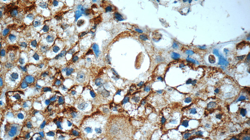 Immunohistochemistry of paraffin-embedded human breast cancer slide using Catalog No:109147(CD9 Antibody) at dilution of 1:50