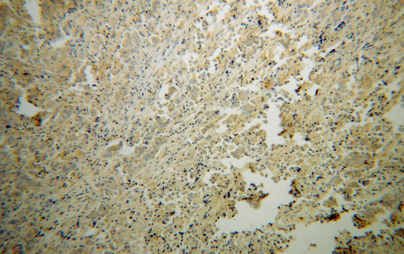 Immunohistochemical of paraffin-embedded human prostate cancer using Catalog No:114115(PPP3R2 antibody) at dilution of 1:50 (under 10x lens)