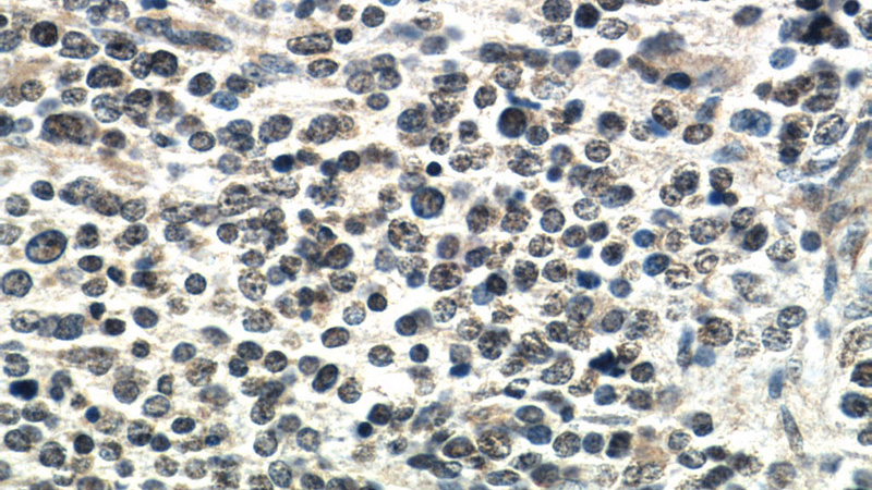 Immunohistochemistry of paraffin-embedded neuroblastoma tissue slide using Catalog No:113862(PHOX2B Antibody) at dilution of 1:50 (under 40x lens)