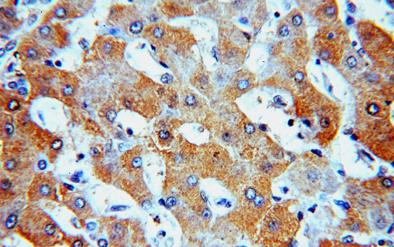 Immunohistochemical of paraffin-embedded human hepatocirrhosis using Catalog No:115639(SPP antibody) at dilution of 1:100 (under 40x lens)