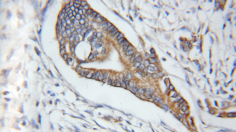 Immunohistochemical of paraffin-embedded human pancreas cancer using Catalog No:109493(COX6A1 antibody) at dilution of 1:100 (under 10x lens)