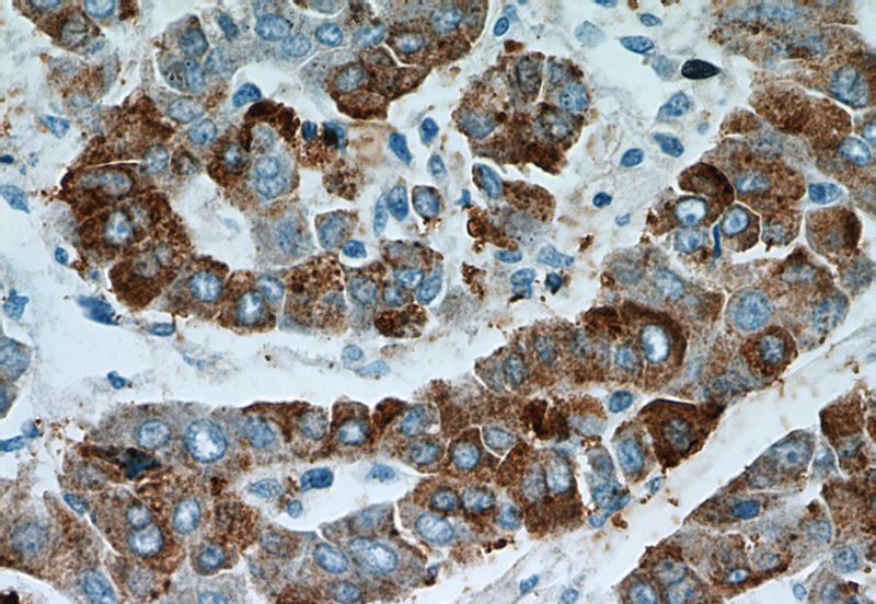 Immunohistochemical of paraffin-embedded human liver cancer using Catalog No:117089(B3GALT6 antibody) at dilution of 1:50 (under 40x lens)