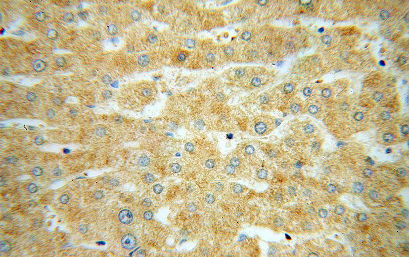 Immunohistochemical of paraffin-embedded human liver cancer using Catalog No:115819(SUCLG1 antibody) at dilution of 1:100 (under 40x lens)