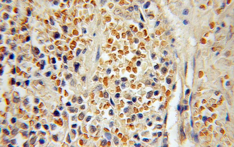 Immunohistochemical of paraffin-embedded human lymphoma using Catalog No:111836(IRF4 antibody) at dilution of 1:50 (under 25x lens)