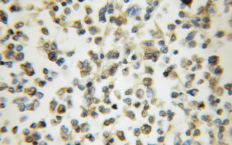 Immunohistochemical of paraffin-embedded human lymphoma using Catalog No:108261(ARHGAP15 antibody) at dilution of 1:50 (under 10x lens)