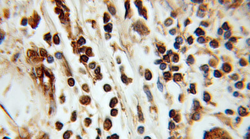 Immunohistochemical of paraffin-embedded human breast cancer using Catalog No:111793(ING3 antibody) at dilution of 1:100 (under 10x lens)