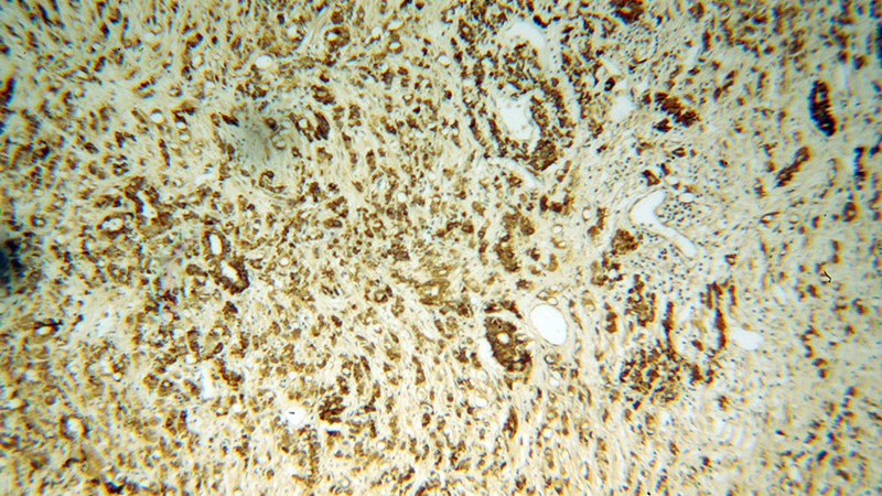 Immunohistochemical of paraffin-embedded human prostate cancer using Catalog No:108256(ARG2 antibody) at dilution of 1:100 (under 10x lens)