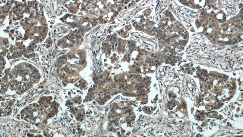 Immunohistochemical of paraffin-embedded human breast cancer using Catalog No:108918(CAMK2D antibody) at dilution of 1:50 (under 10x lens)