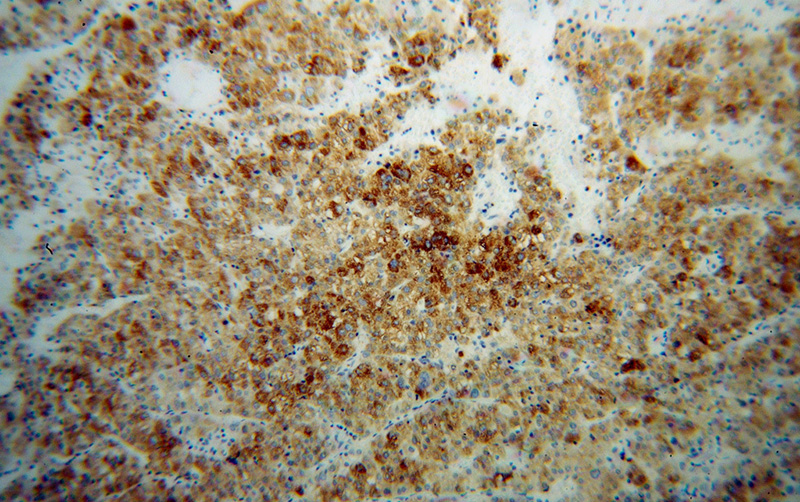 Immunohistochemical of paraffin-embedded human liver cancer using Catalog No:109705(CYP4F11 antibody) at dilution of 1:100 (under 10x lens)