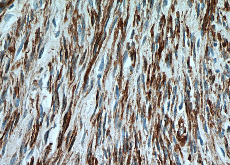 Immunohistochemical of paraffin-embedded human hysteromyoma using Catalog No:107705(ACTA2 antibody) at dilution of 1:50 (under 40x lens)
