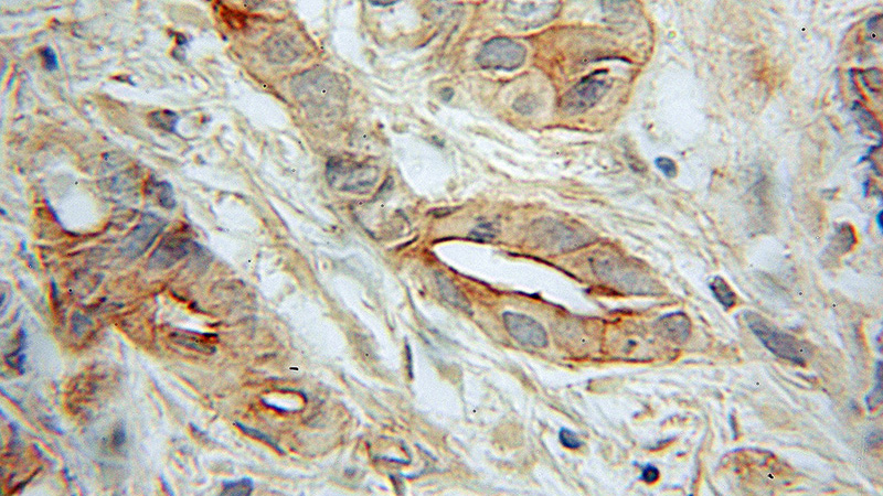 Immunohistochemical of paraffin-embedded human prostate cancer using Catalog No:115444(SNAP23 antibody) at dilution of 1:50 (under 10x lens)