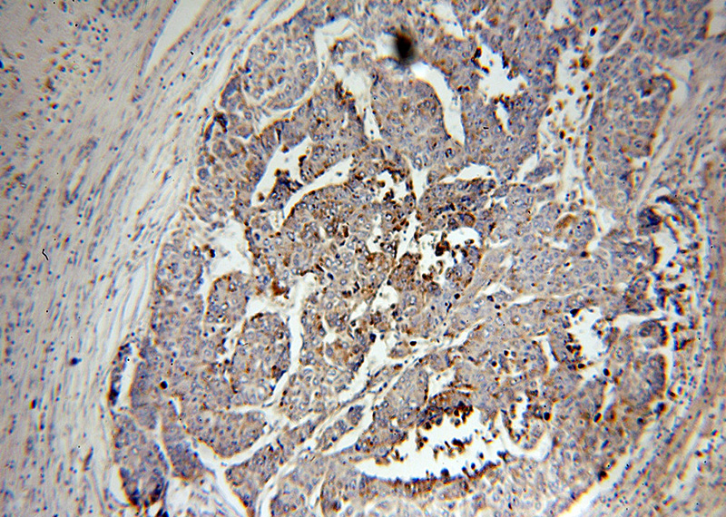 Immunohistochemical of paraffin-embedded human liver cancer using Catalog No:114289(PSAP antibody) at dilution of 1:100 (under 10x lens)
