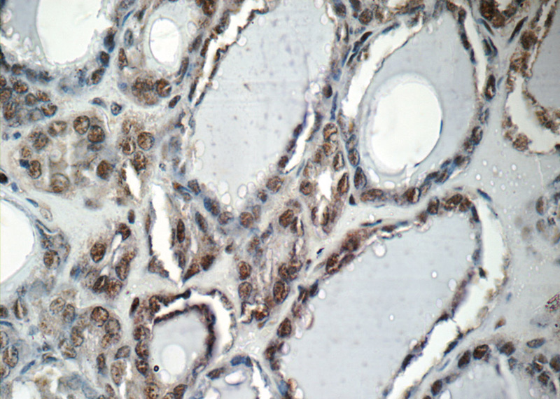 Immunohistochemistry of paraffin-embedded human thyroid tissue slide using Catalog No:109545(CREB1 Antibody) at dilution of 1:50 (under 40x lens)
