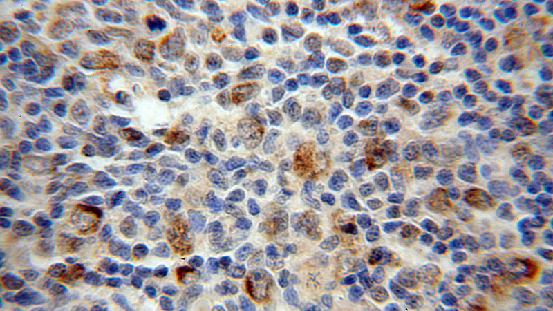 Immunohistochemical of paraffin-embedded human lymphoma using Catalog No:112632(MEF2C antibody) at dilution of 1:50 (under 40x lens)