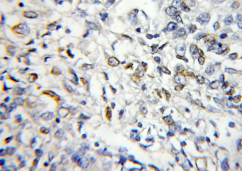 Immunohistochemical of paraffin-embedded human lung cancer using Catalog No:114501(RABL2B antibody) at dilution of 1:50 (under 10x lens)