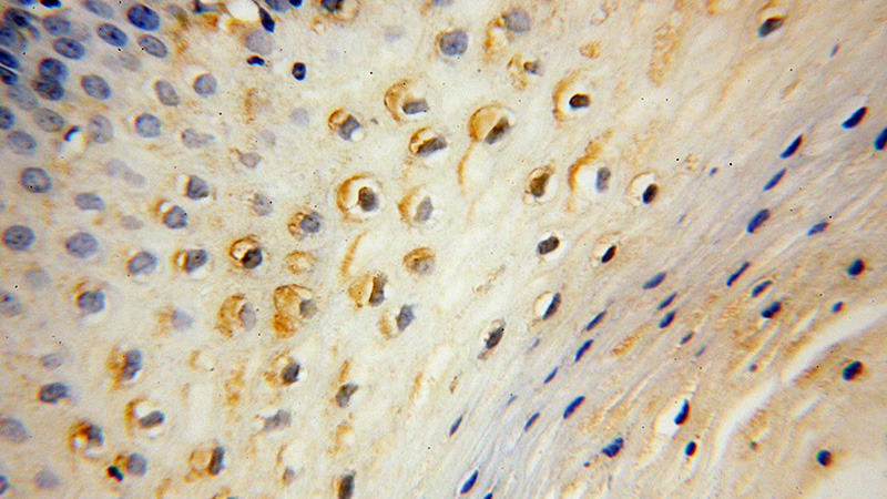 Immunohistochemical of paraffin-embedded human cervix using Catalog No:109914(DGKQ antibody) at dilution of 1:50 (under 40x lens)